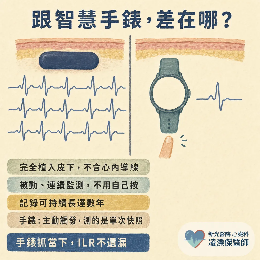 植入式心電圖記錄器（ILR）是什麼？反覆昏倒、中風找不到原因為什麼要裝、怎麼裝、能戴多久 圖卡 3