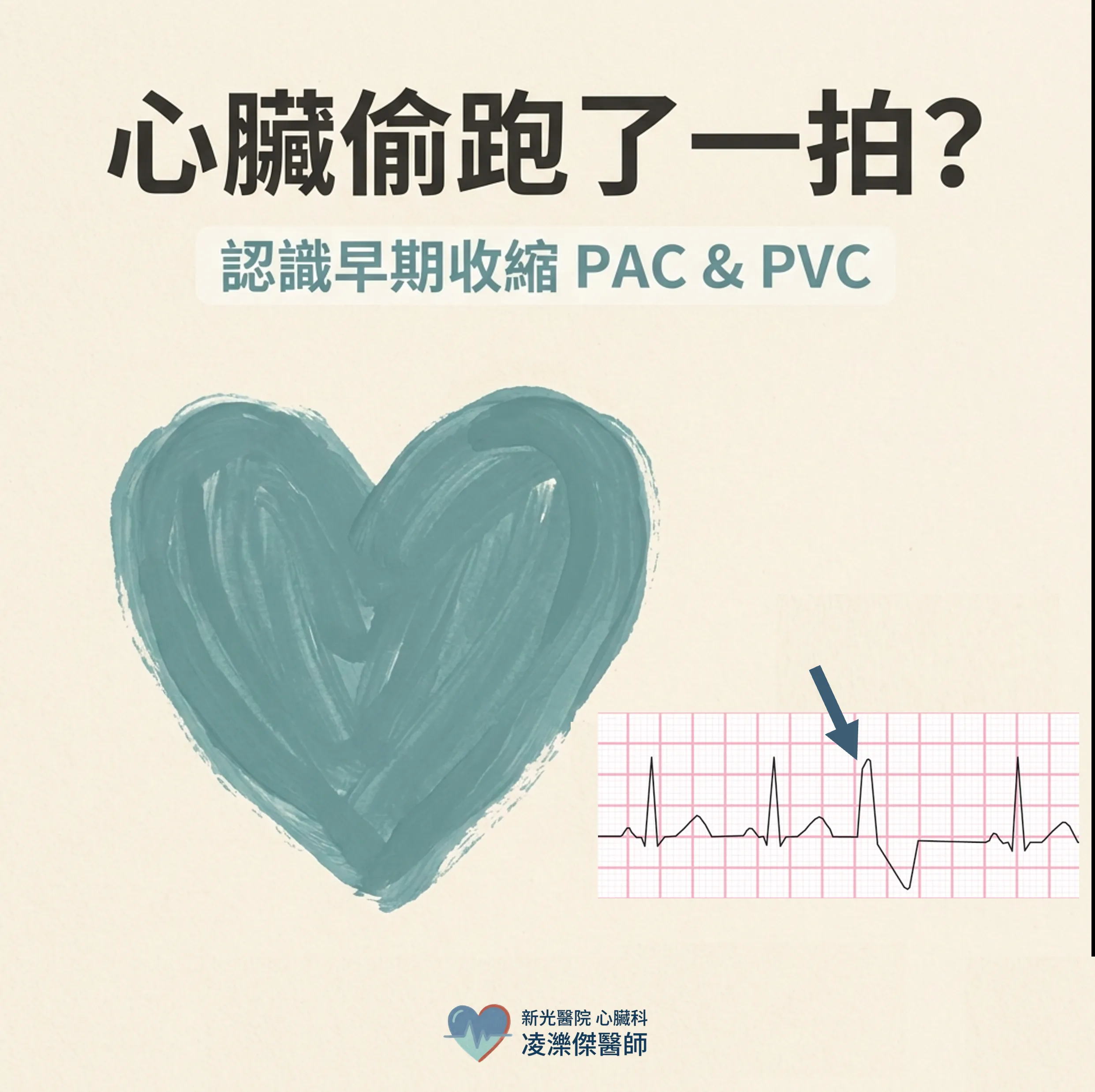 PAC/PVC 早期收縮是什麼?心臟偷跑、心跳漏拍要治療嗎 圖卡 1